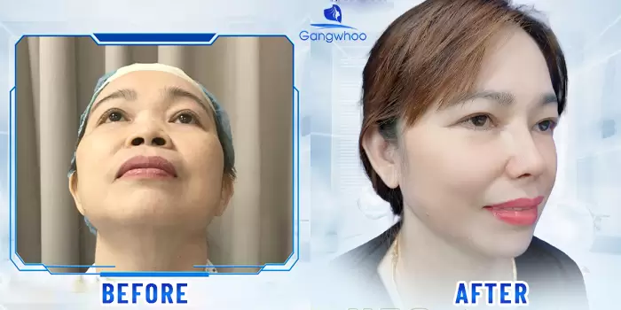 Alar Base Reduction – Slimmer, More Charming, Better