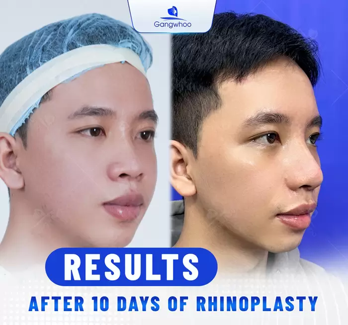 Cartilage Rhinoplasty – Amazing 5-steps Technique To Treat Nose Redness