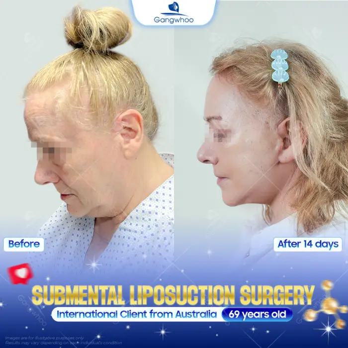 Korean Rhinoplasty – The Secret to Owning a Korean Nose Shape