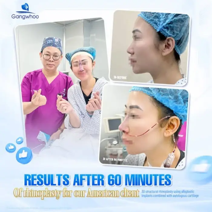 Korean Rhinoplasty – The Secret to Owning a Korean Nose Shape