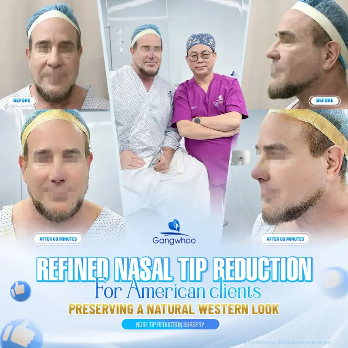Korean Rhinoplasty – The Secret to Owning a Korean Nose Shape