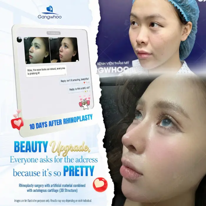Korean Rhinoplasty – The Secret to Owning a Korean Nose Shape