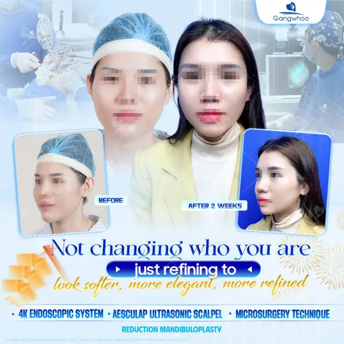 Korean Rhinoplasty – The Secret to Owning a Korean Nose Shape
