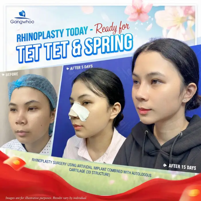 Korean Rhinoplasty – The Secret to Owning a Korean Nose Shape