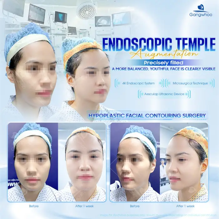 Korean Rhinoplasty – The Secret to Owning a Korean Nose Shape