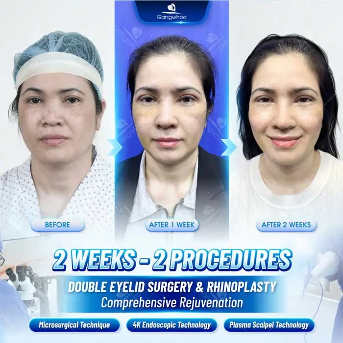 2025 Top Rhinoplasty Techniques
