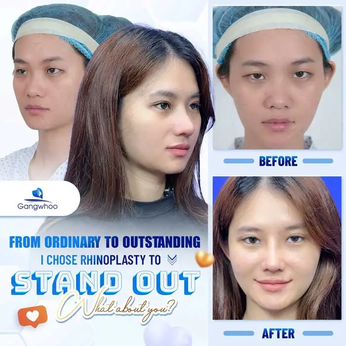 2025 Top Rhinoplasty Techniques