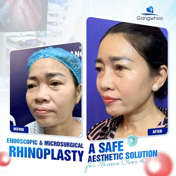 2025 Top Rhinoplasty Techniques