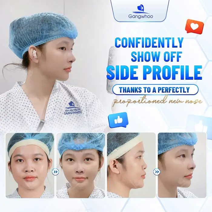 2025 Top Rhinoplasty Techniques