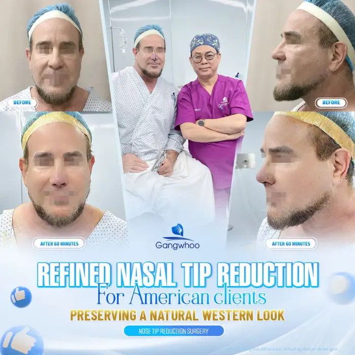 Nose Tip Reduction – Perfect and Delicate Nose Than Ever