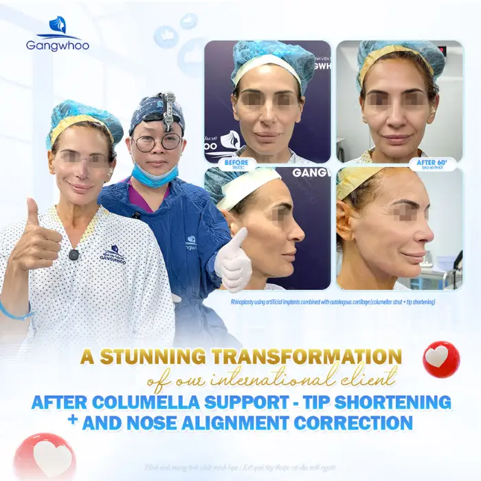 Nose Tip Reduction – Perfect and Delicate Nose Than Ever