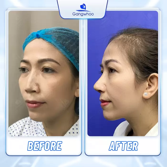 Rib Cartilage Rhinoplasty – Get Rid Of All Nose Flaws