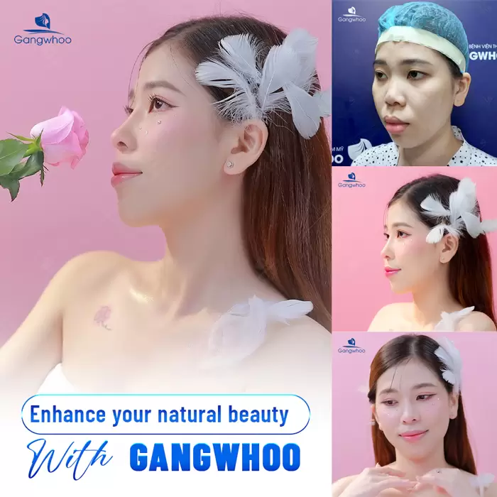 Rib Cartilage Rhinoplasty – Get Rid Of All Nose Flaws