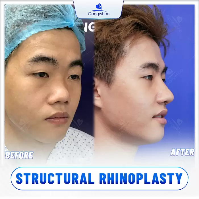 Structural Rhinoplasty – Nose Defects Are No Longer Your Concern