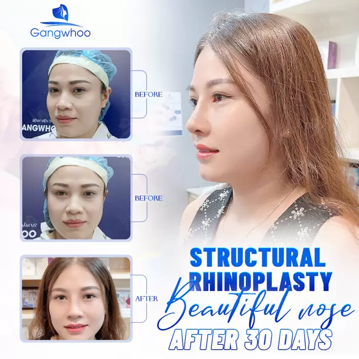 Structural Rhinoplasty – Nose Defects Are No Longer Your Concern