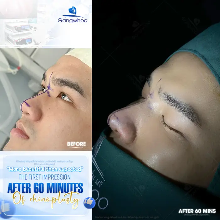 Structural Rhinoplasty – Remedy Nose Defects