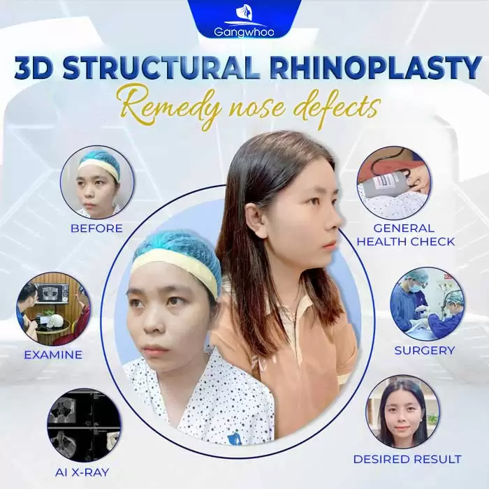 Structural Rhinoplasty – Nose Defects Are No Longer Your Concern