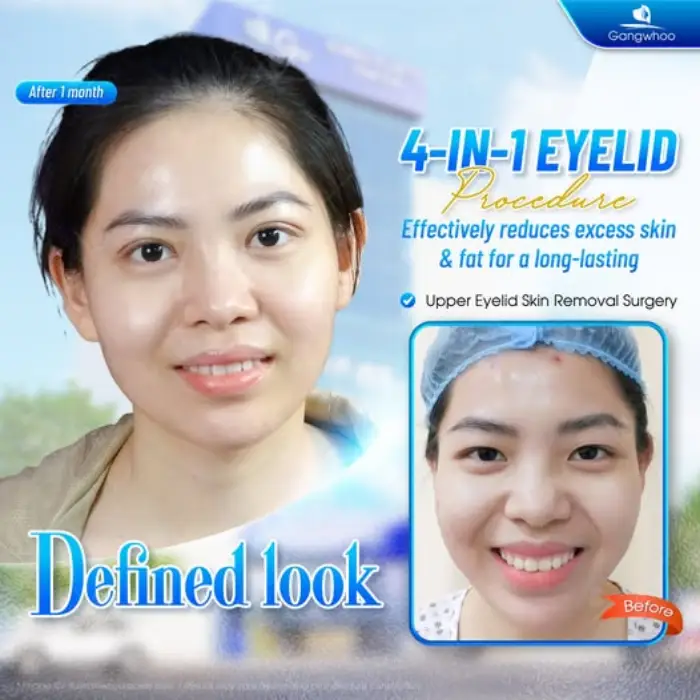 4 in 1 Plasma Incisional Blepharoplasty – Begone All Defects and Flaws