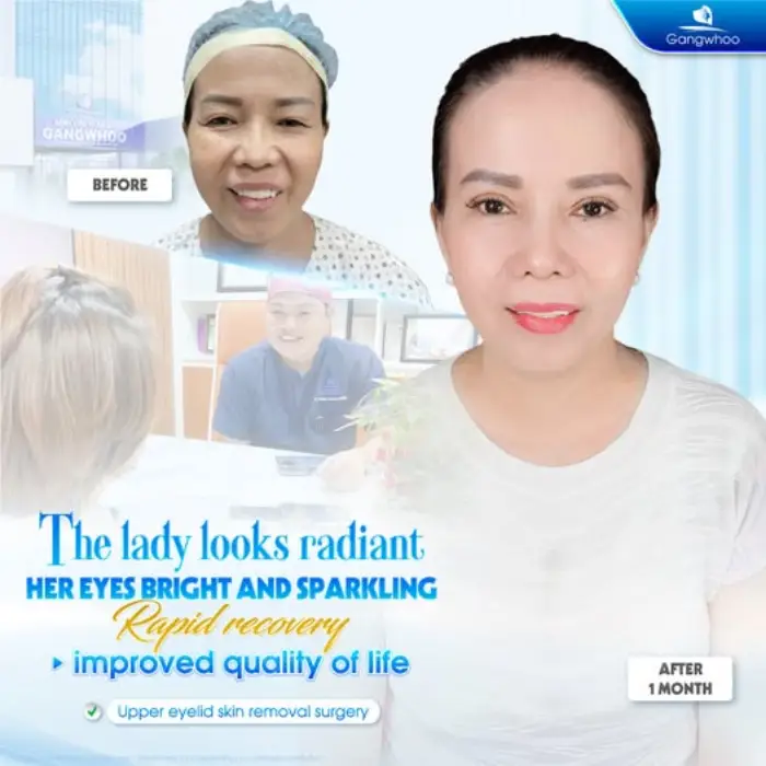 4 in 1 Plasma Incisional Blepharoplasty – Begone All Defects and Flaws