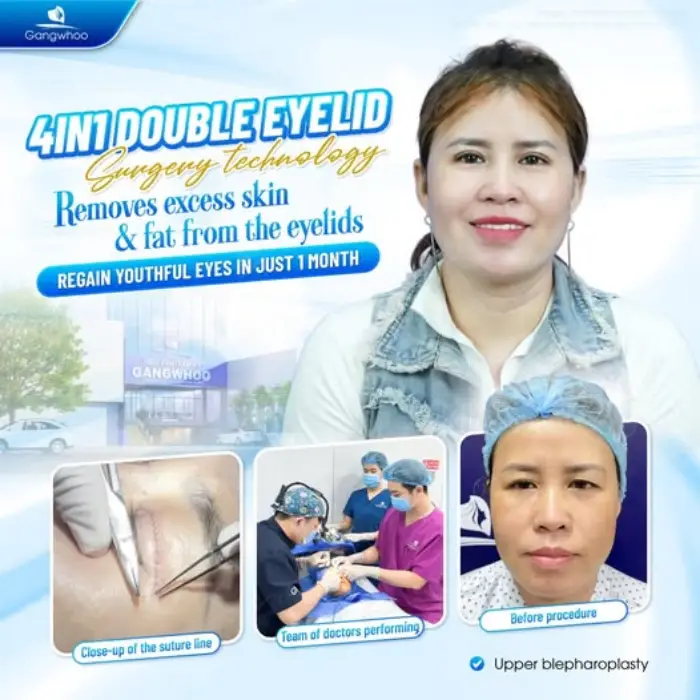 4 in 1 Plasma Incisional Blepharoplasty – Begone All Defects and Flaws