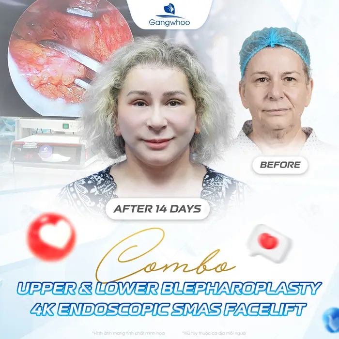 Blepharoplasty – Always Be On Top