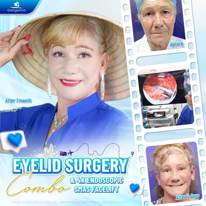 Blepharoplasty – Always Be On Top