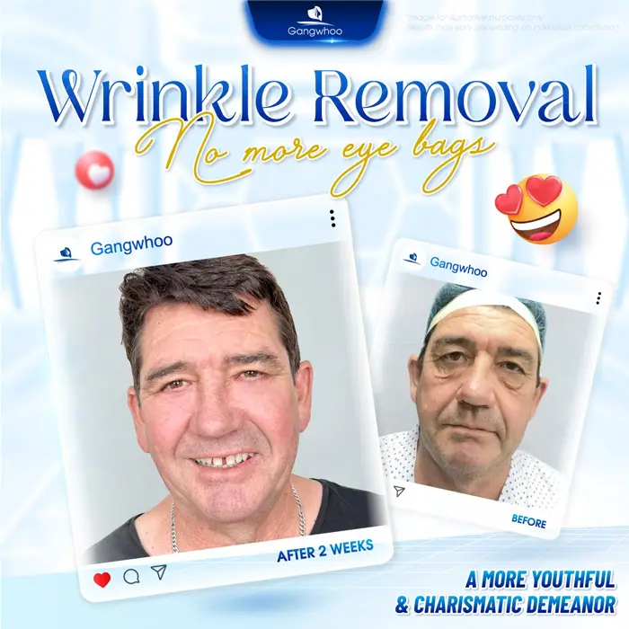Blepharoplasty – Always Be On Top