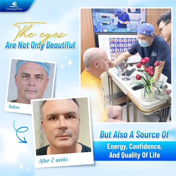 Blepharoplasty – Always Be On Top