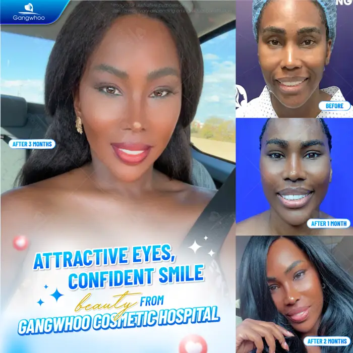 Blepharoplasty – Always Be On Top