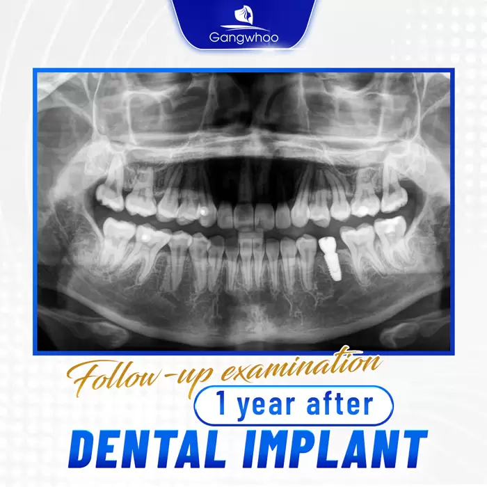 Dental Implant – For A Perfect Set Of Teeth