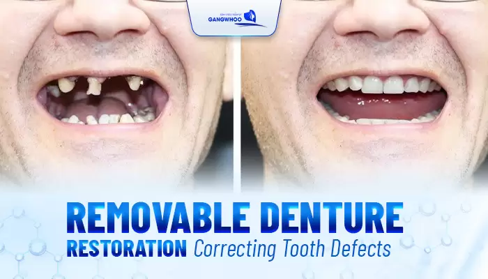 Dentures Reinstall and Recovery