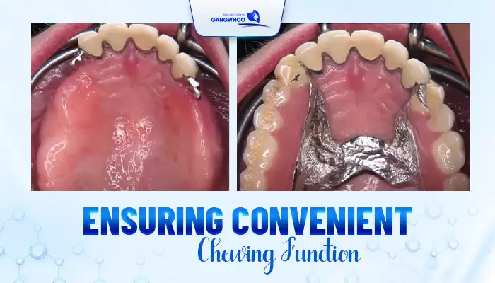 Dentures Reinstall and Recovery