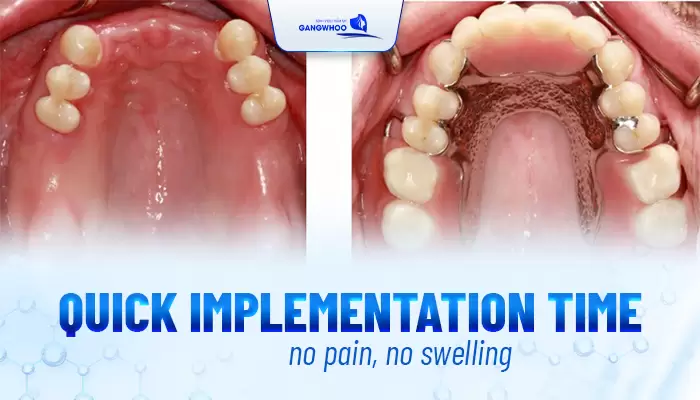 Dentures Reinstall and Recovery