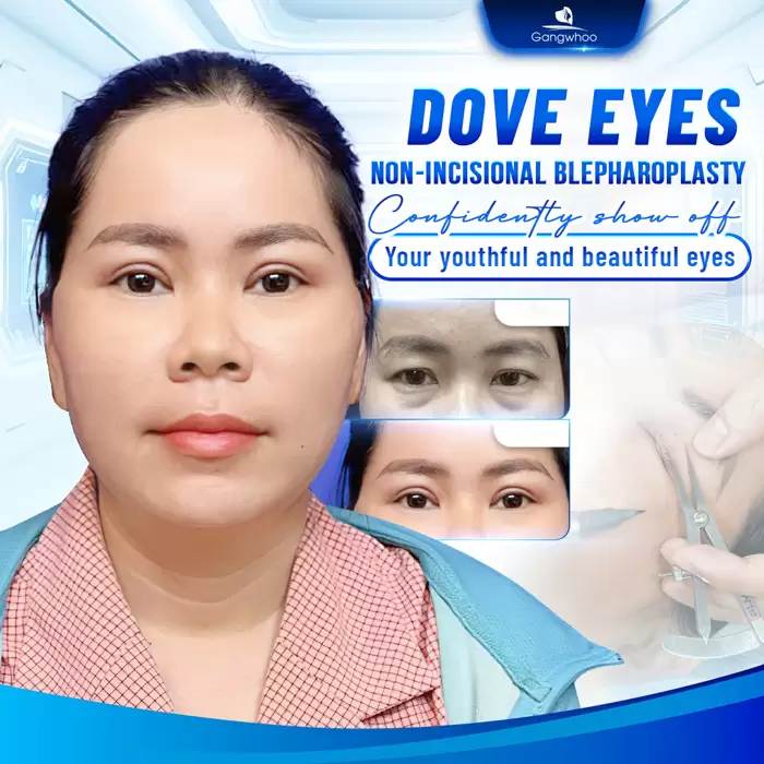 Dove Eyes Non-incisional Blepharoplasty – Bring Lovely Eyes To Your Life