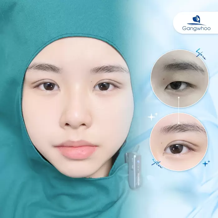 Dove Eyes Non-incisional Blepharoplasty – Bring Lovely Eyes To Your Life