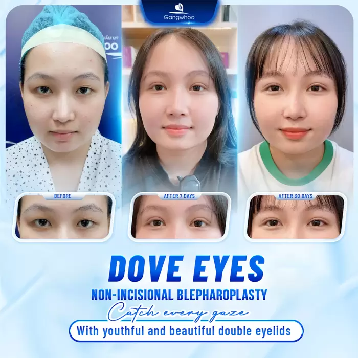 Dove Eyes Non-incisional Blepharoplasty – Bring Lovely Eyes To Your Life