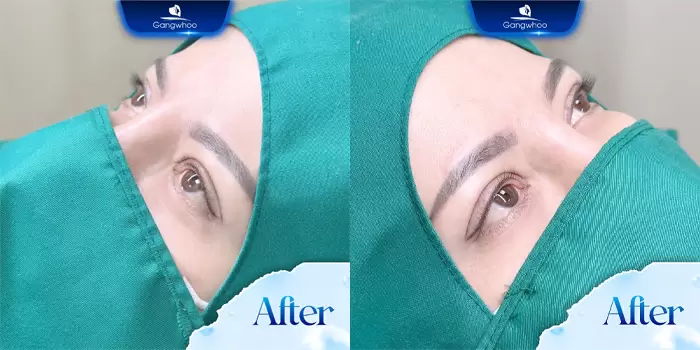 Dove Eyes Non-incisional Blepharoplasty – Bring Lovely Eyes To Your Life