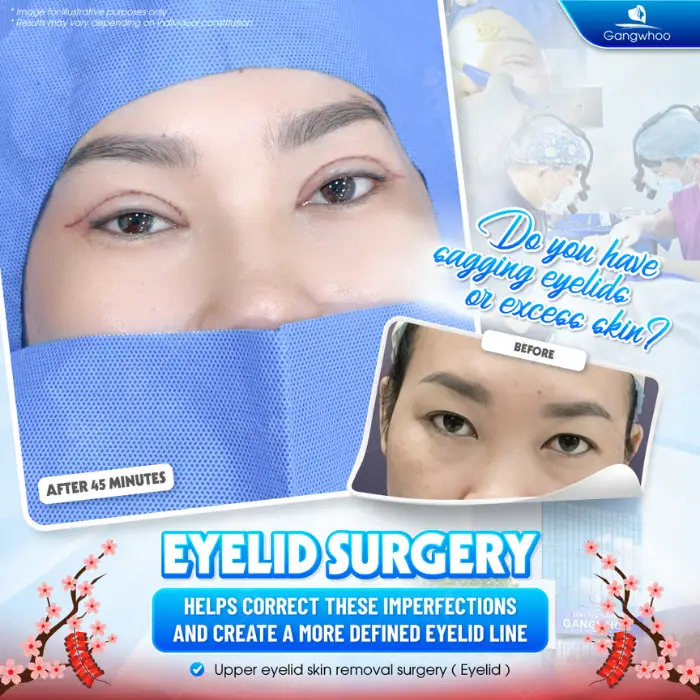 Korean Incisional Blepharoplasty – Be An Idol Now