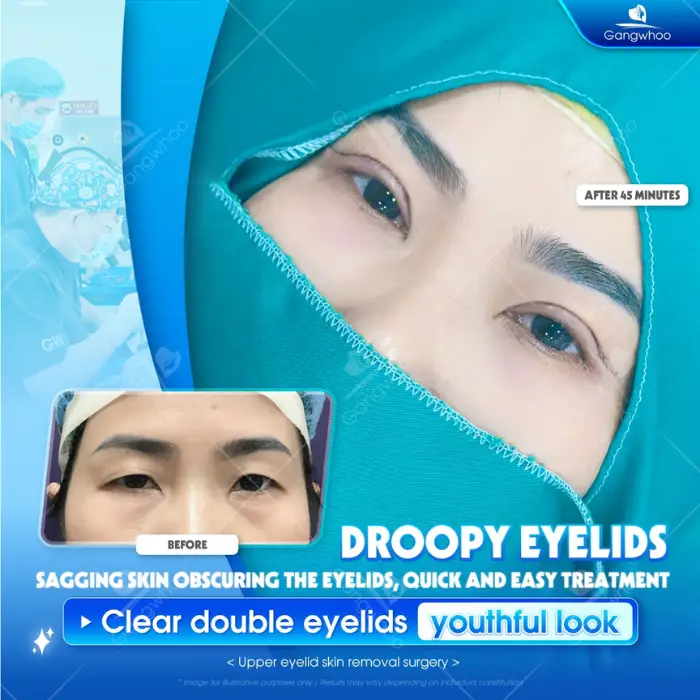 Korean Incisional Blepharoplasty – Be An Idol Now