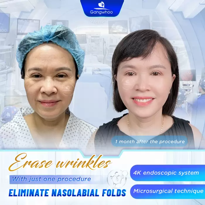 Nasolabial Fold Augmentation – Get Rid Of The Wrinkles Of Time