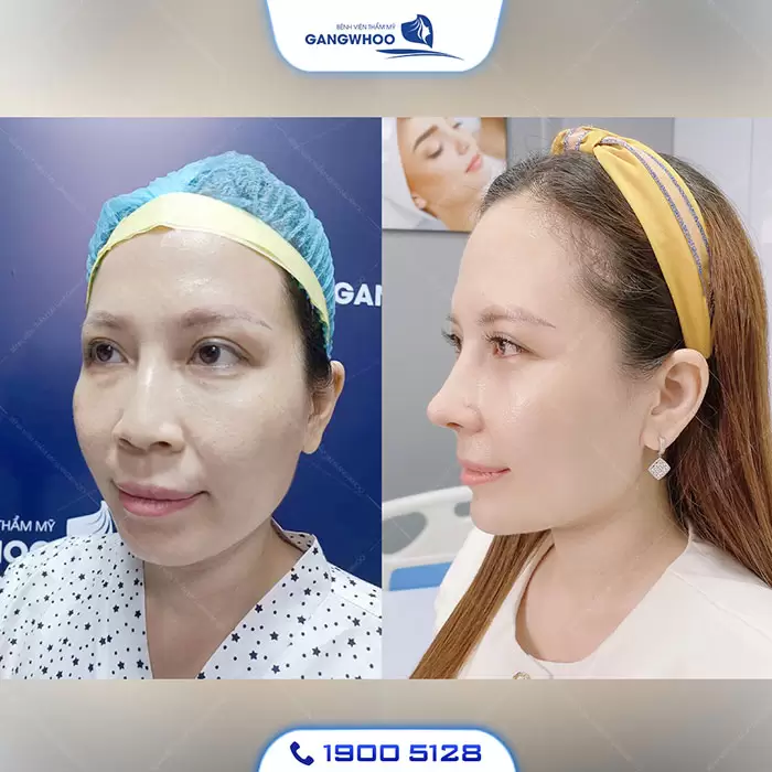 Nasolabial Fold Augmentation – Get Rid Of The Wrinkles Of Time