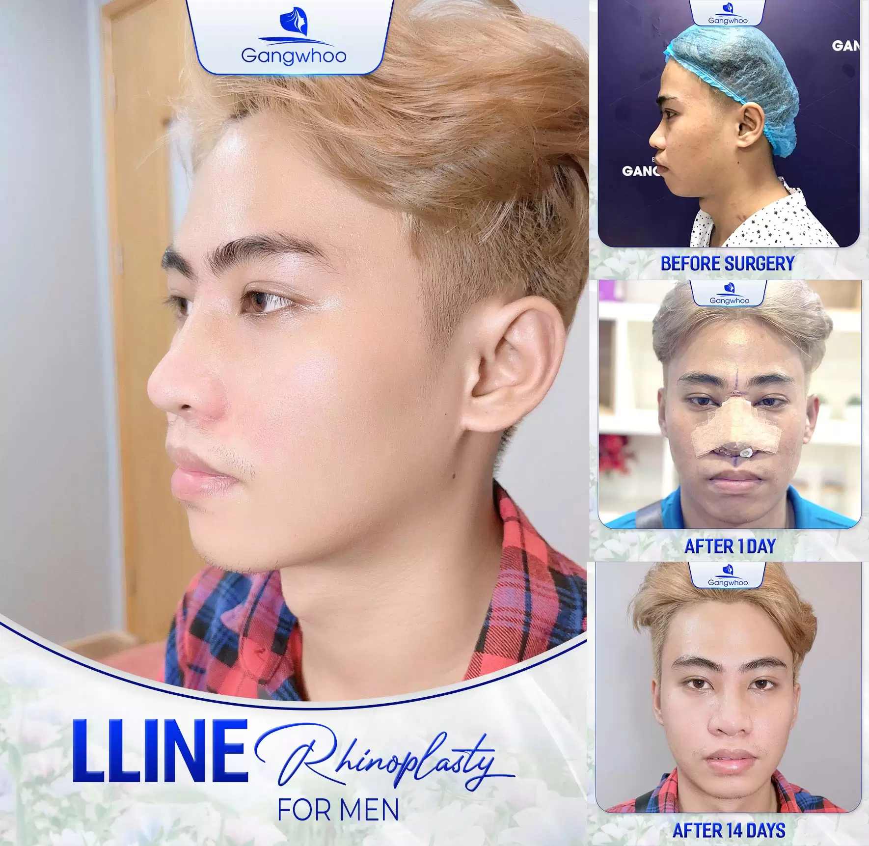 Rhinoplasty For Men – A Gentleman Of Beauty