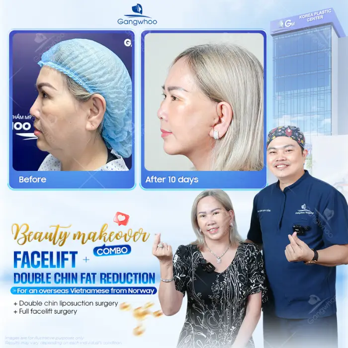 Chin Liposuction – Destroy Chin Fat In A Glance