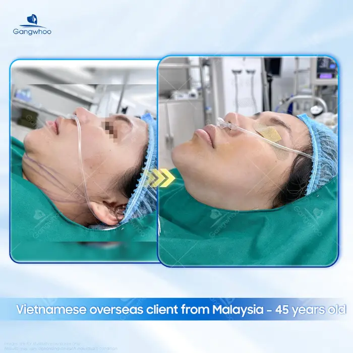 Chin Liposuction – Destroy Chin Fat In A Glance