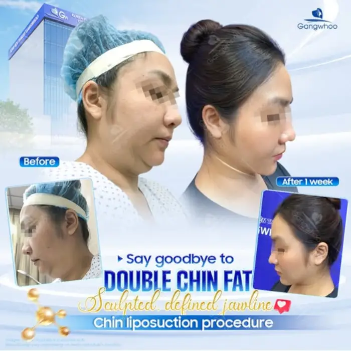 Chin Liposuction – Destroy Chin Fat In A Glance