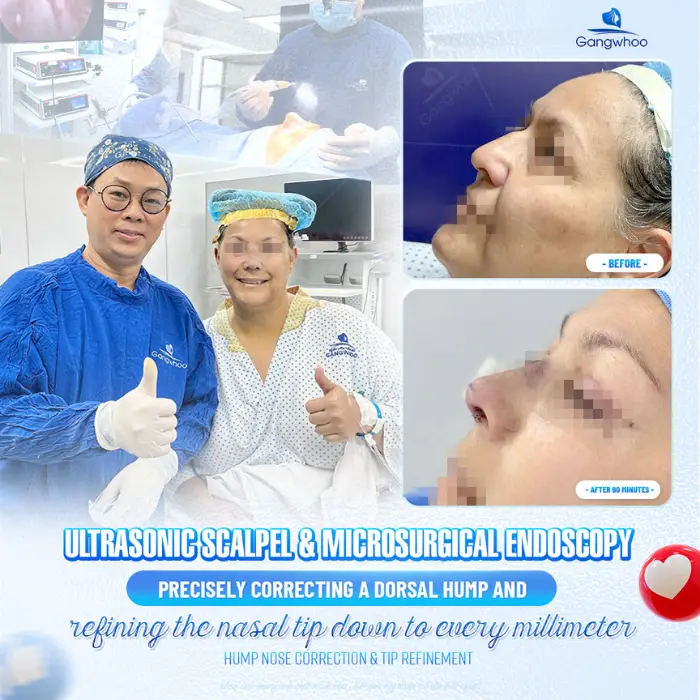 Complete Nose Revision – To Overcome Failed Rhinoplasty