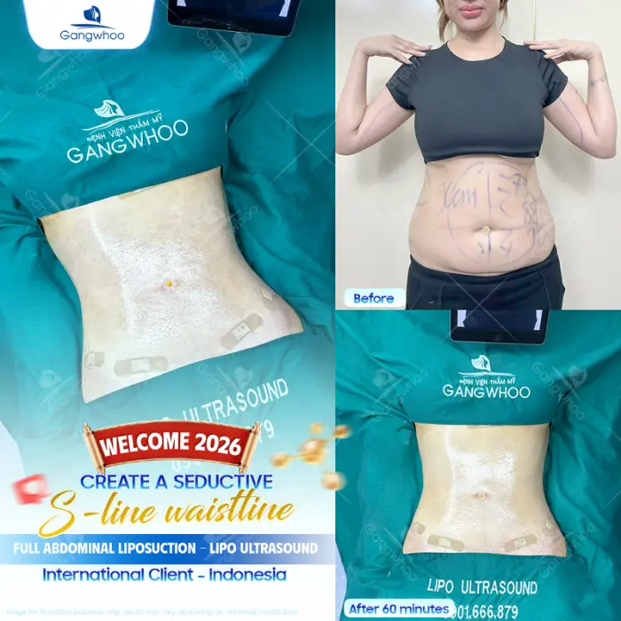 Complete Waist Liposuction – Become A Model Now