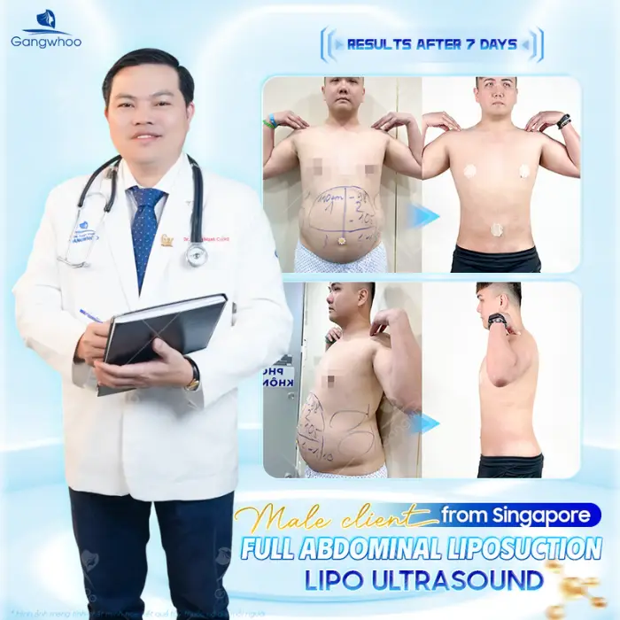 Complete Waist Liposuction – Become A Model Now