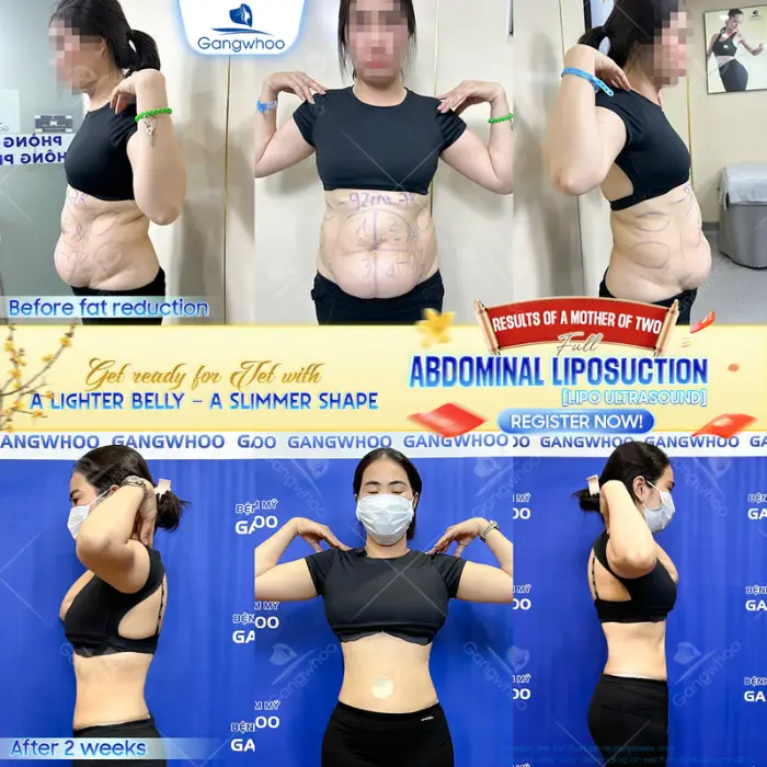 Complete Waist Liposuction – Become A Model Now