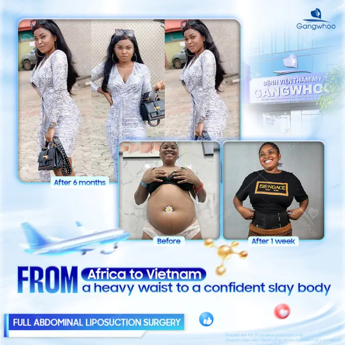 Complete Waist Liposuction – Become A Model Now